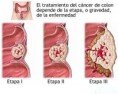 /album/fotogaleria/cancercolon-1-jpg1/